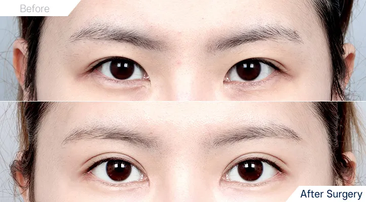 Upper blepharoplasty
