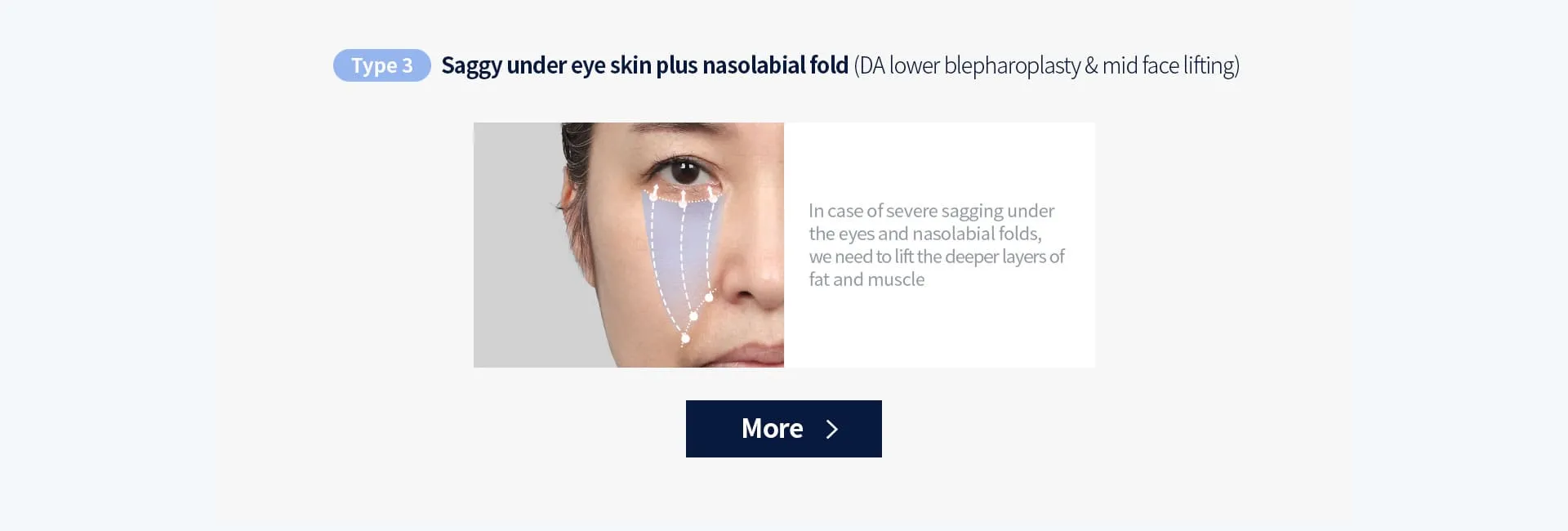 Lower blepharoplasty
