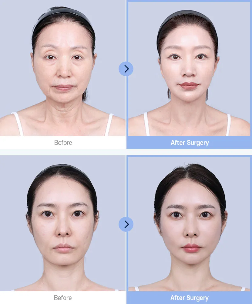 Fat Injection(Full face)