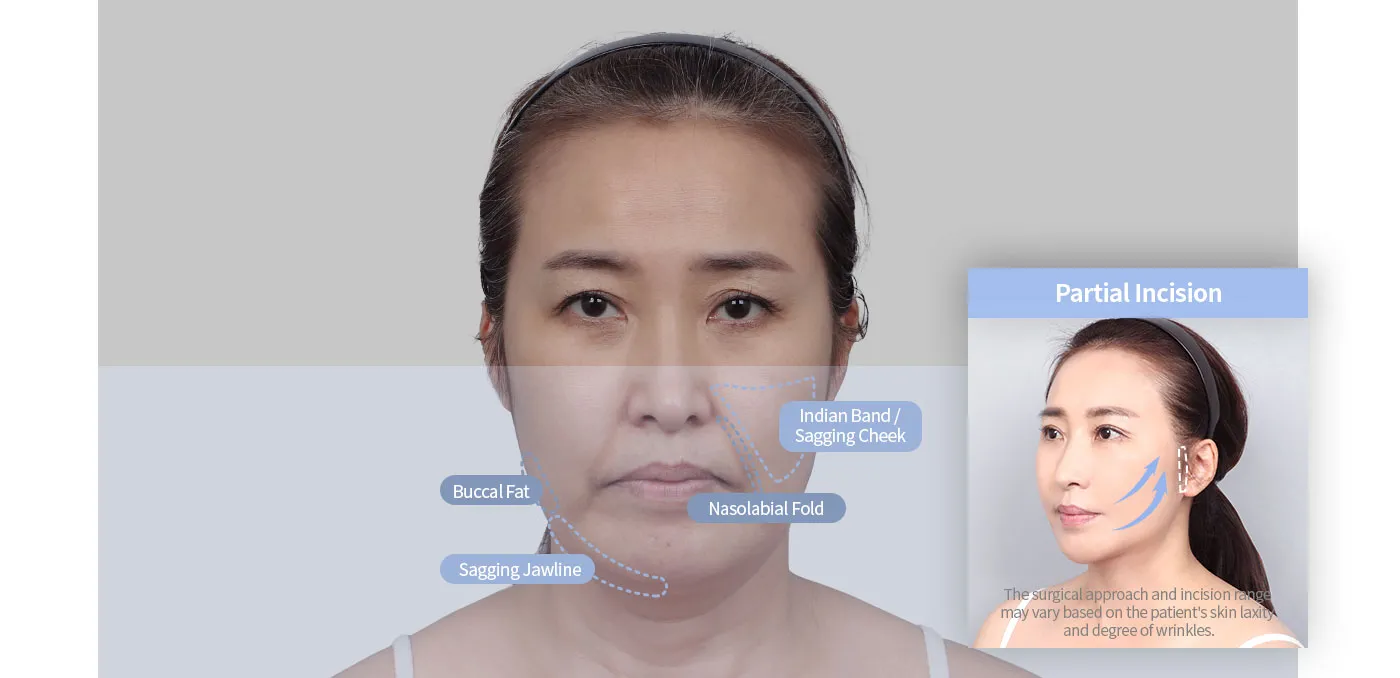 Fat Injection(Full face)