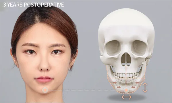 3 pcs Facial contouring