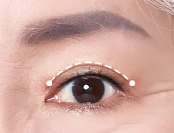 Upper blepharoplasty