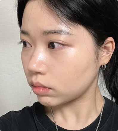 Revision Rhino plasty