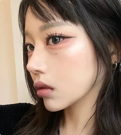 Revision Rhino plasty