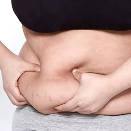 Lipo suction(abdomen)