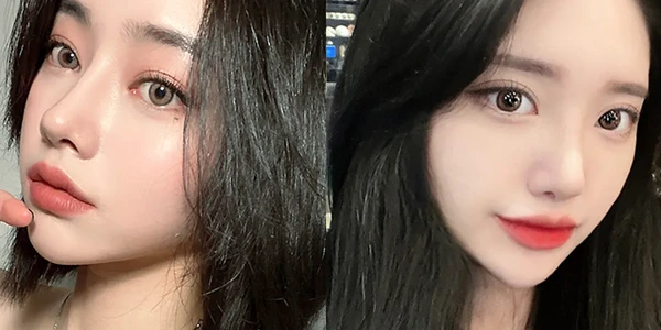 Upper blepharoplasty